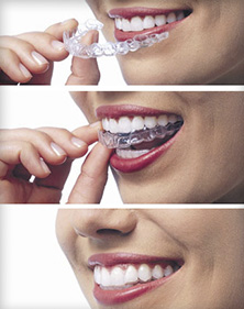 A person inserting an Invisalign aligner.