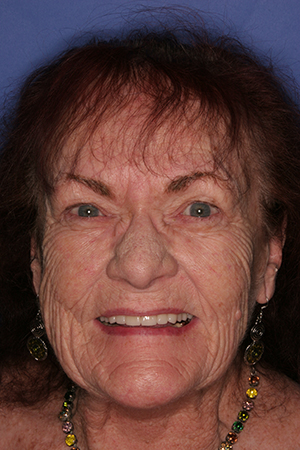 Billings dentist patient Lorria after photos