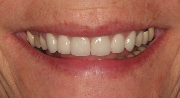 Cosmetic dentist in Billings MT after photos