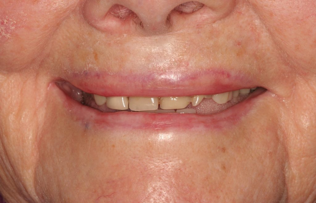 Smile Gallery Dentistry Before and After Dentist in Billings MT