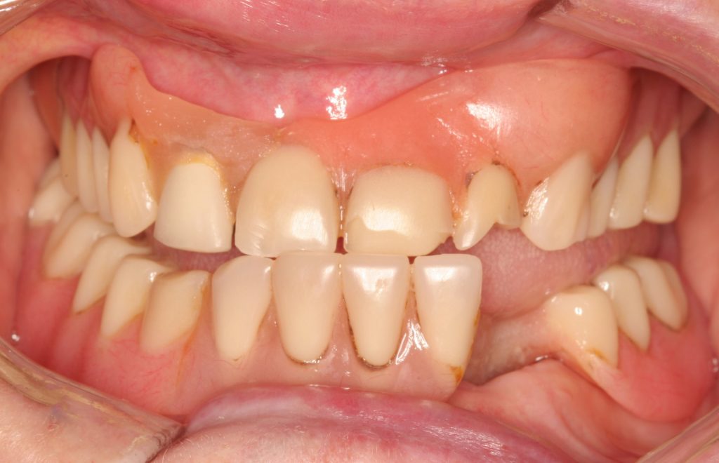 Smile Gallery Dentistry Before and After Dentist in Billings MT