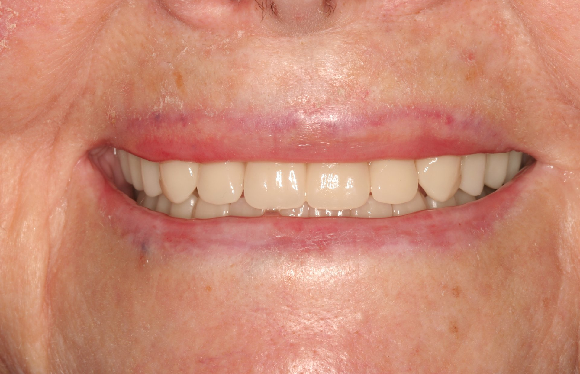 Dentures in Billings MT with Dr. Johnson before and after