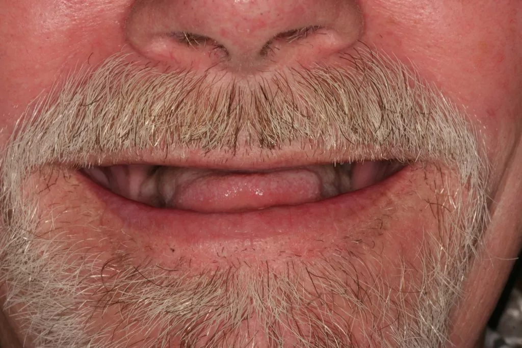 Smile Gallery Dentistry Before and After Dentist in Billings MT