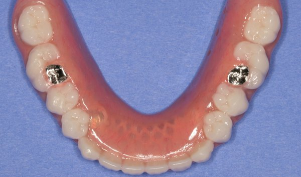 Tooth implants for implant dentures in Billings