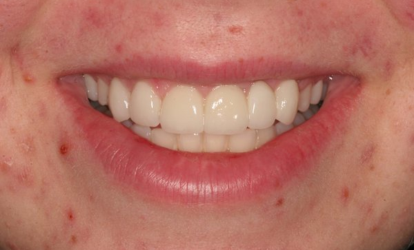 Dr. Johnson's patient before and after photos at The Billings Dentist