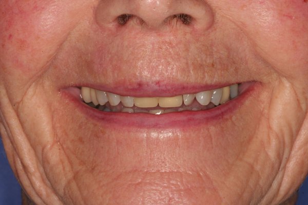 Missing tooth replacement in Billings MT before photos