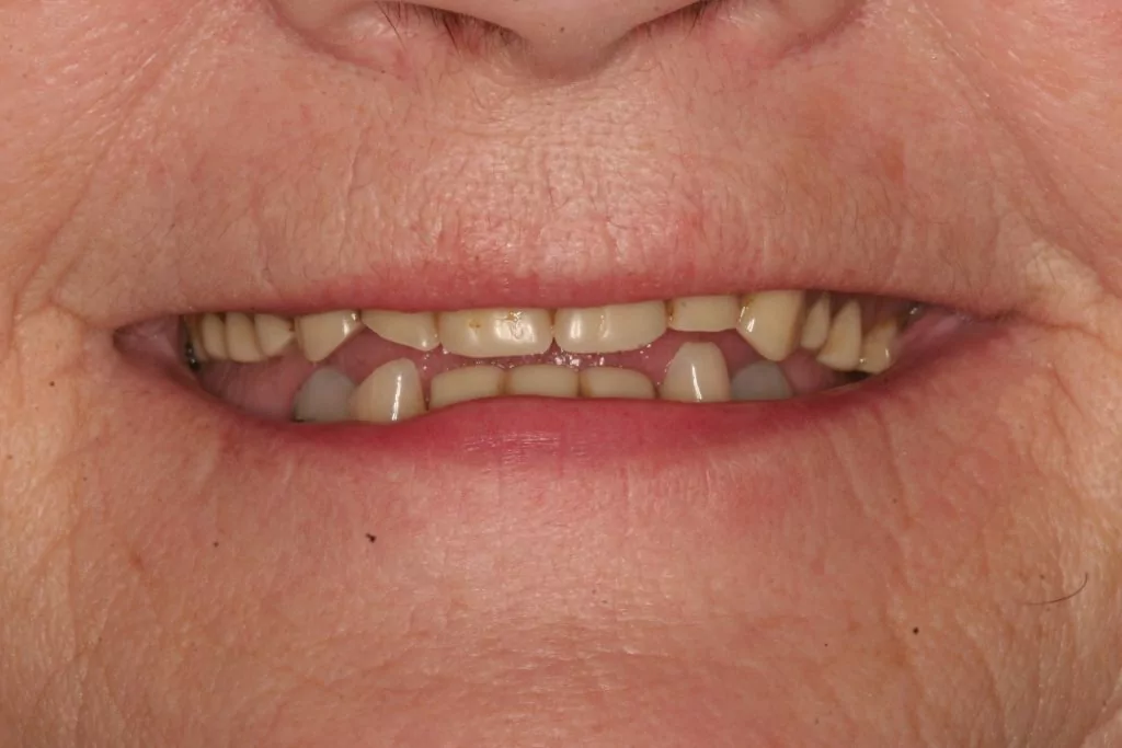 Smile Gallery Dentistry Before and After Dentist in Billings MT