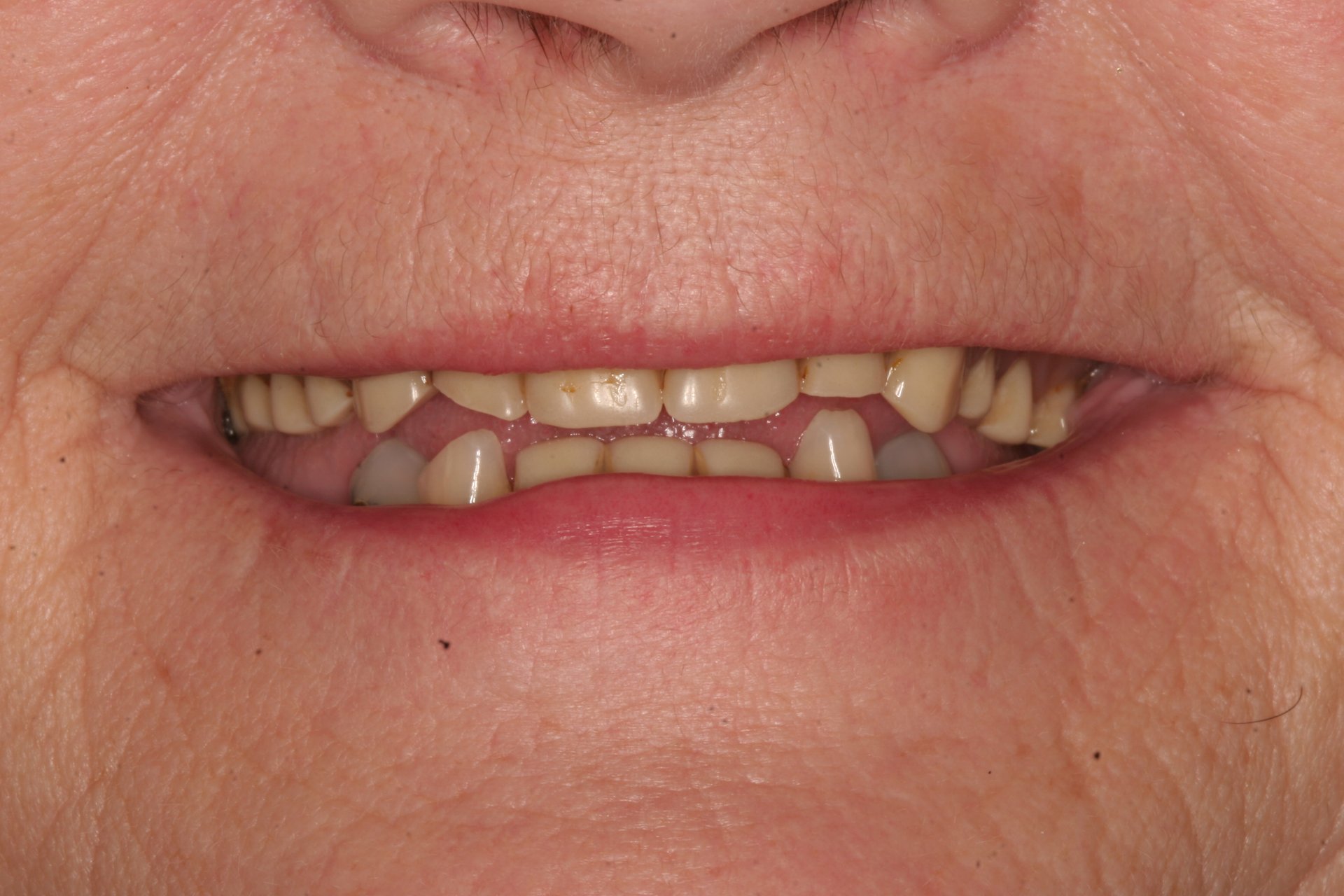 Mary Billings MT dentist patient before photos