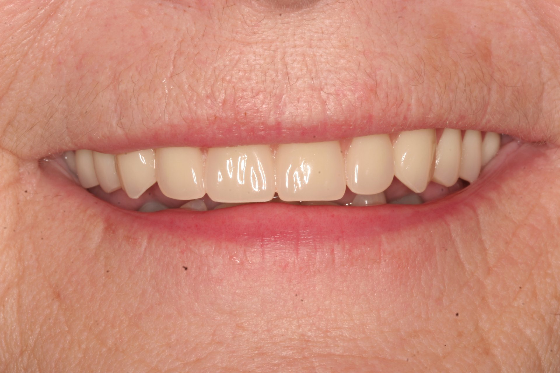 Mary Billings MT dentist patient after photos