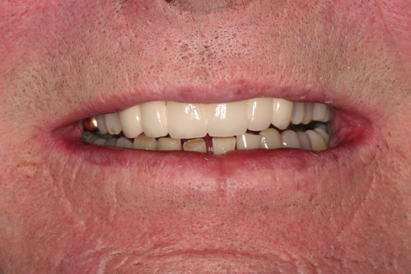 Dr. Johnson restorative dentist photos before and after