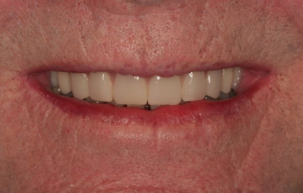 Patient with denture implants at The Billings dentist