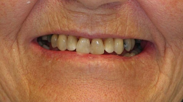 Before implant dentures patient photos