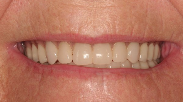 Patient with new smile from denture implants in Billings with Dr. Johnson