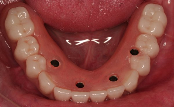 Implant dentures before being attached