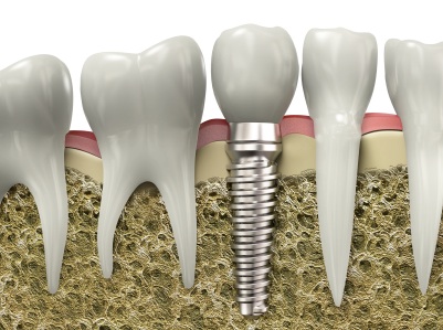 A graphic image of a dental implant embedded in a jawbone after treatment in Billings.