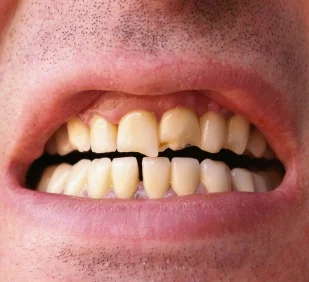 A man with broken teeth in need of cosmetic bonding in Billings.